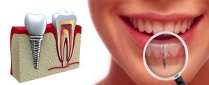 Ce este un implant dentar?